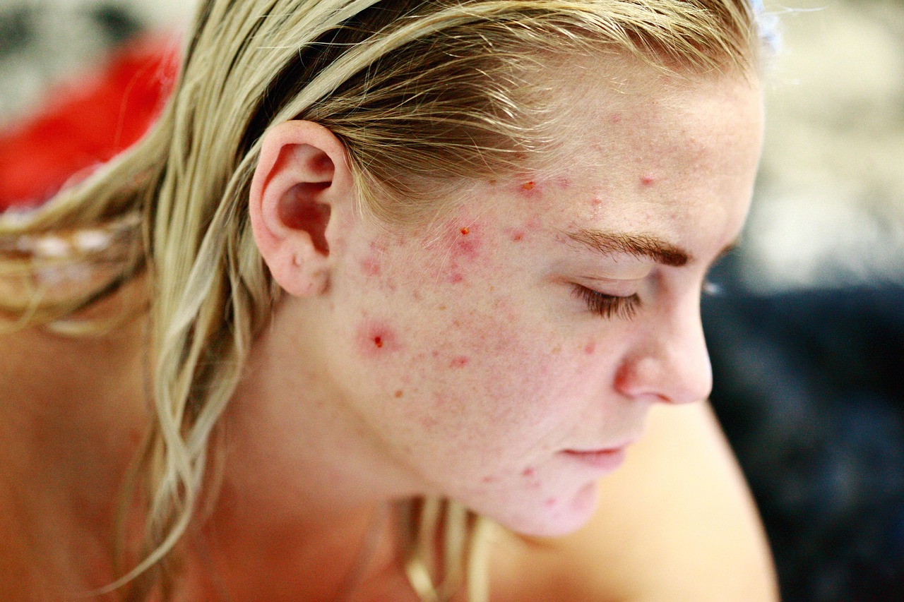 Close-up of a person with acne reflecting the challenges of skin treatment in an AI regulatory framework